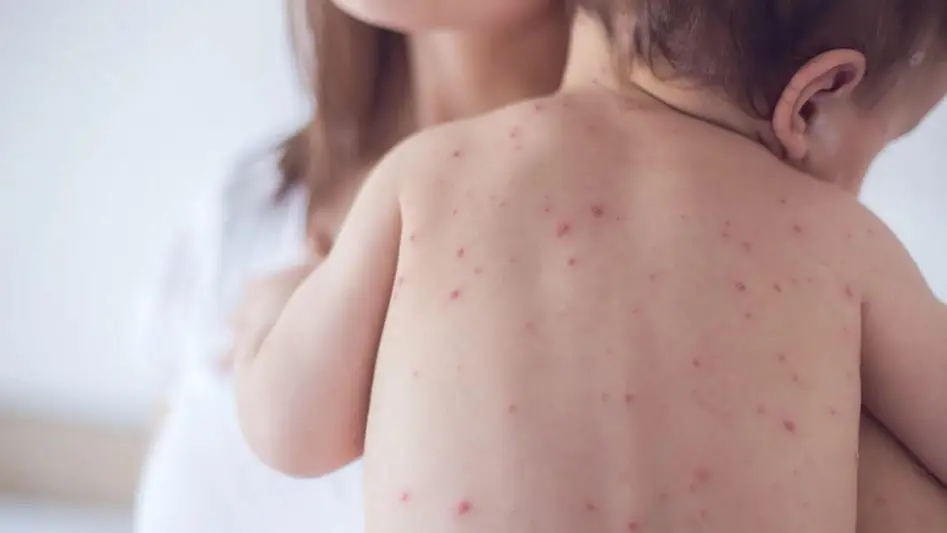 Aumento de casos de sarampo em países vizinhos acende alerta em Rondônia