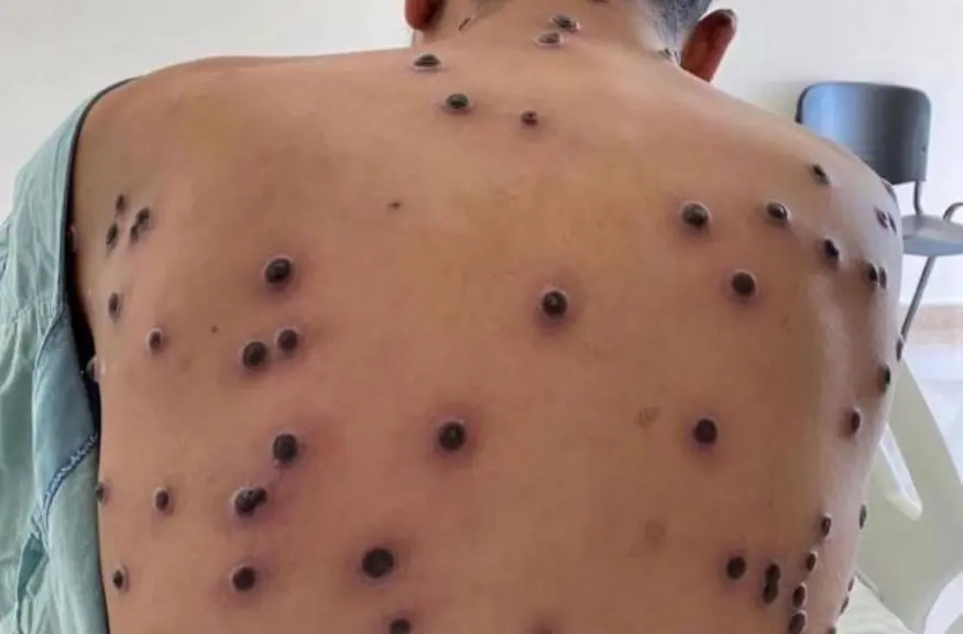 Porto Velho registra primeiro caso confirmado de Mpox e dois suspeitos